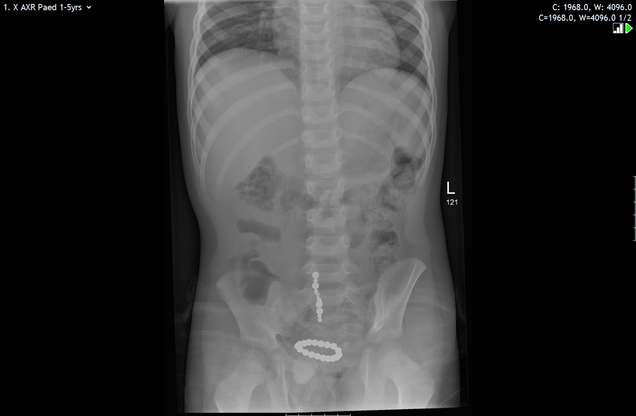 xray-magnet-in-gut